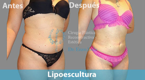 Lipoescultura