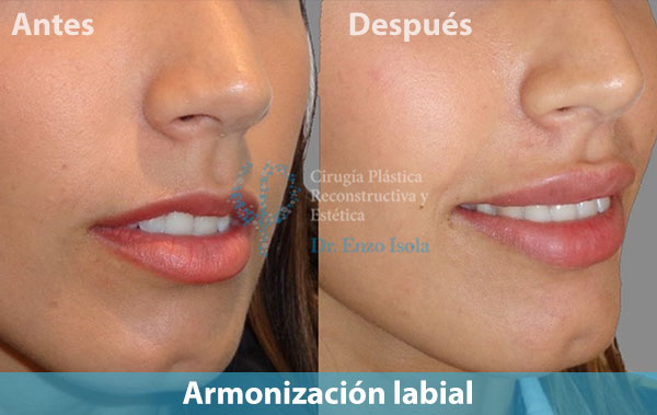 Antes y después del procedimiento estético de Armonización labial