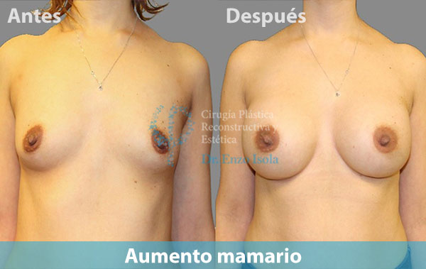 Antes y después del procedimiento estético de Aumento mamario
