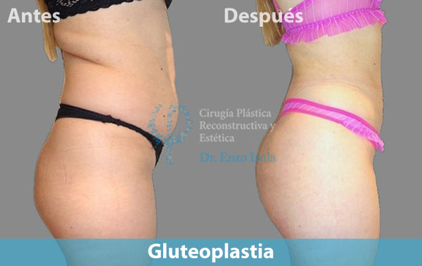 Antes y después del procedimiento estético de Gluteoplastia