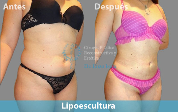 Antes y después del procedimiento estético de Lipoescultura