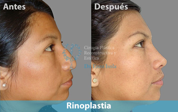 Antes y después del procedimiento estético de Rinoplastia