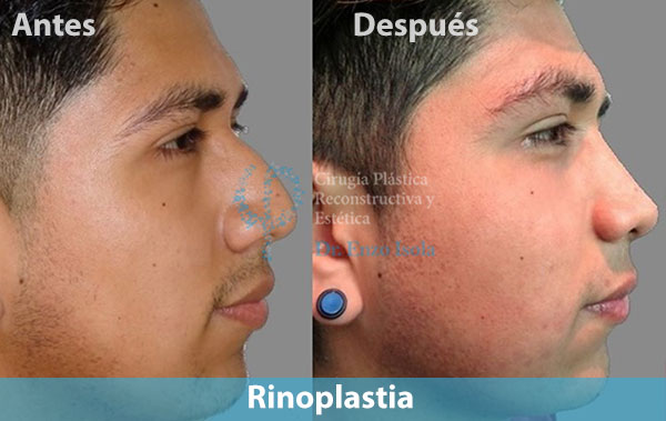Antes y después del procedimiento estético de Rinoplastia
