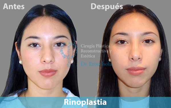 Antes y después del procedimiento estético de Rinoplastia