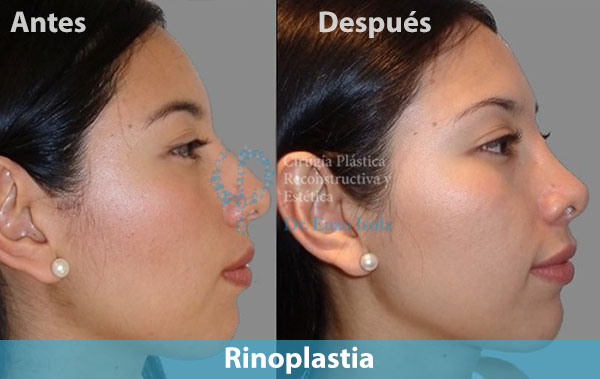 Antes y después del procedimiento estético de Rinoplastia