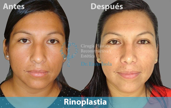 Antes y después del procedimiento estético de Rinoplastia