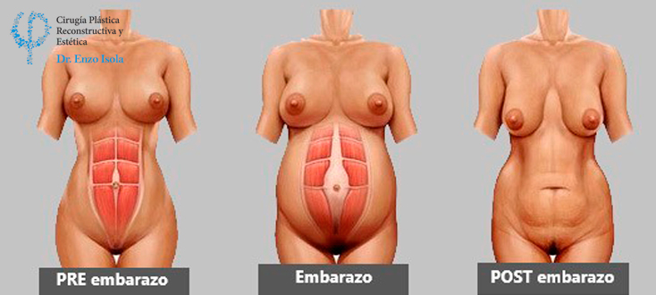 Lipo abdominoplastia - Objetivos