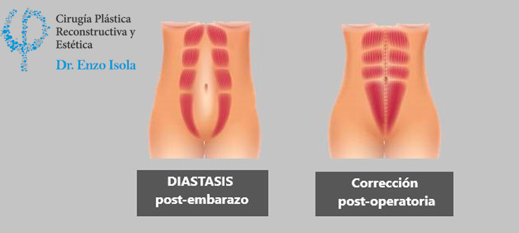 Lipo abdominoplastia - Preparación pre-operatoria