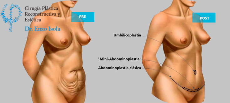 Lipo abdominoplastia -  La operación