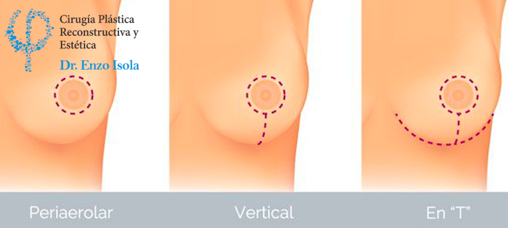 Mastopexia - Tiempo operatorio
