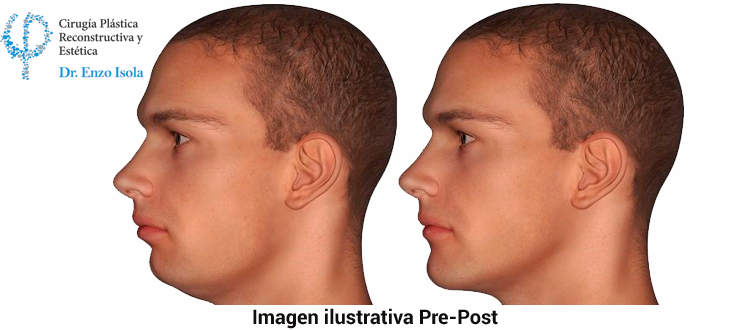 Mentoplastia - El post-operatorio