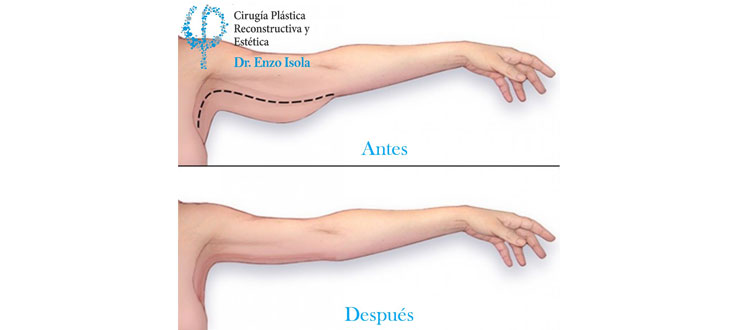 Braquioplastia - Objetivos