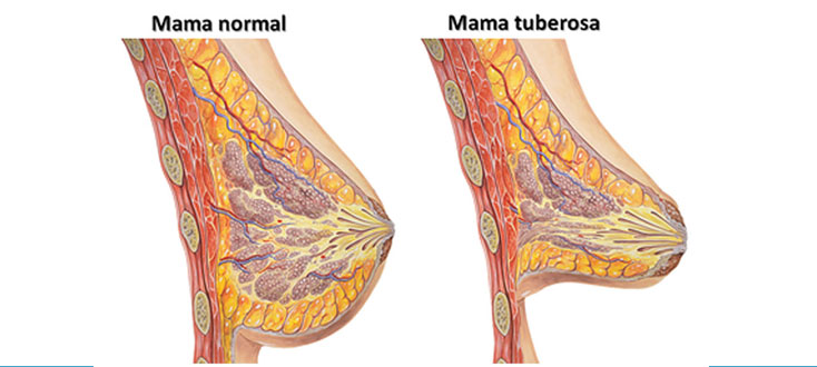 Senos tuberosos - Explicación