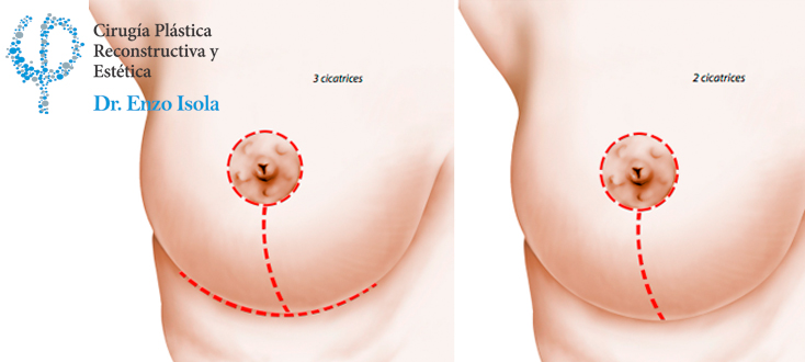 Reducción mamaria - Tiempo operatorio