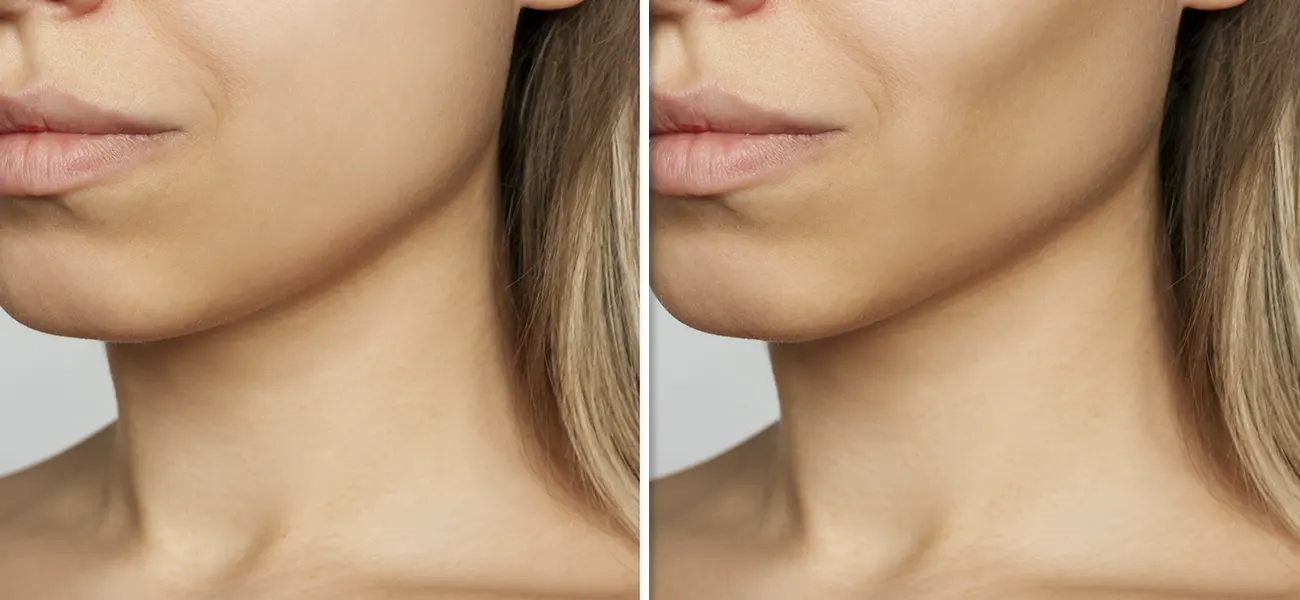 Dr. Enzo Isola • Rinoplastia