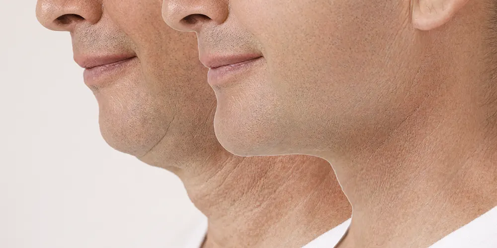 Dr. Enzo Isola • Lifting cervical