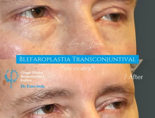 Blefaroplastía Transconjuntivial 02
