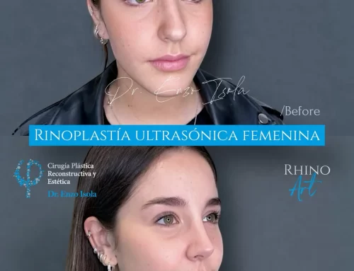 Rinoplastía ultrasónica 1 B