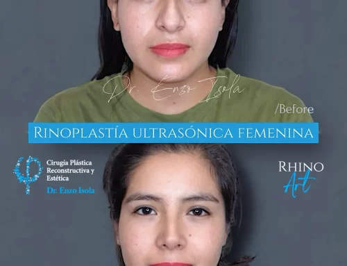 Rinoplastía ultrasónica 2 A