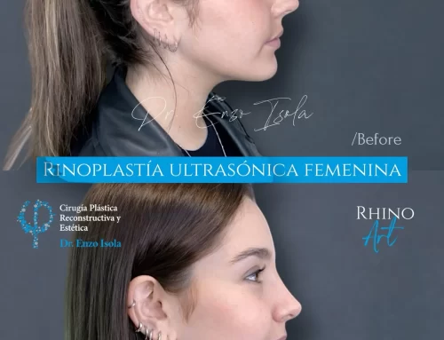 Rinoplastía ultrasónica 1 C