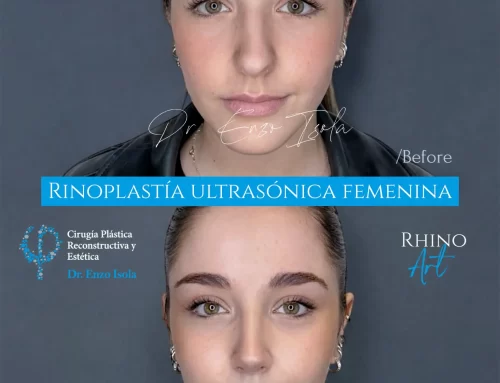 Rinoplastía ultrasónica 1 A
