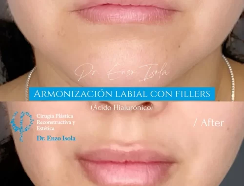 Armonización facial con fillers 2 A