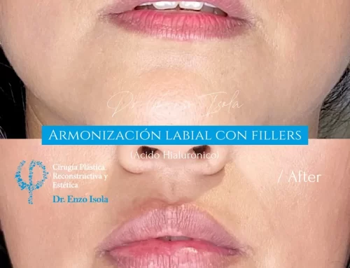 Armonización facial con fillers 3 A