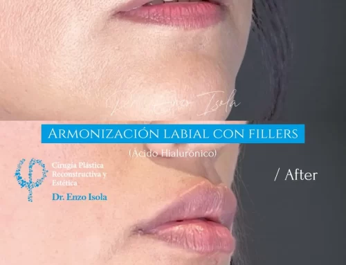 Armonización facial con fillers 3 B