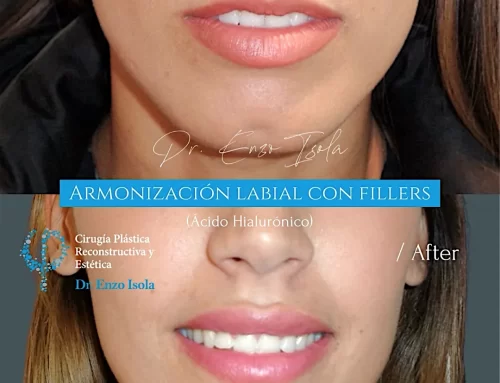 Armonización facial con fillers 4 A