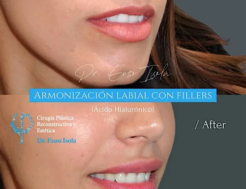 Armonización facial con fillers 4 B