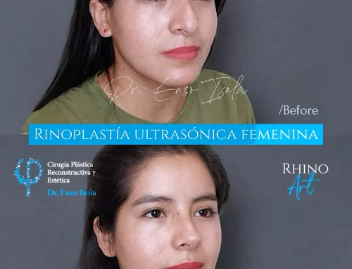 Rinoplastía ultrasónica 2 B